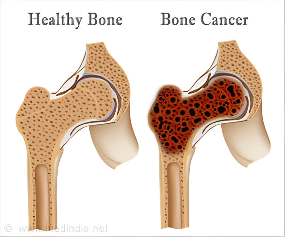 Shedding Light on Sarcoma and Bone Cancer: A Call for Awareness